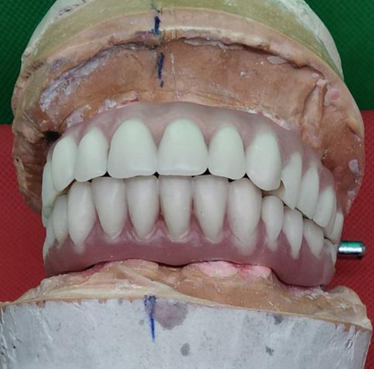 Implant hybrid danger