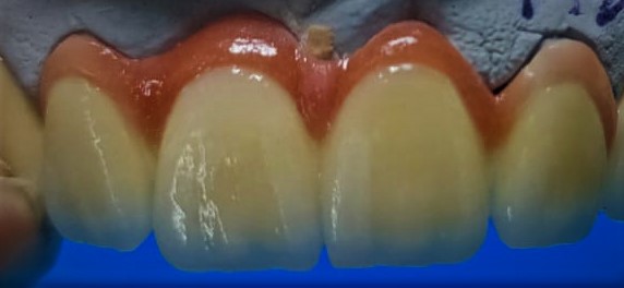 ZIRCONIA Explore Aesthetic